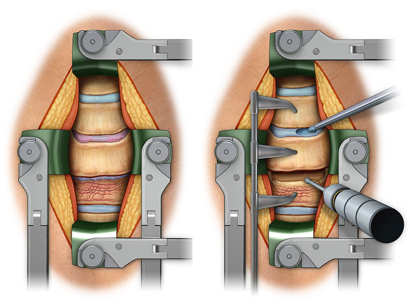 Cervical Fusion