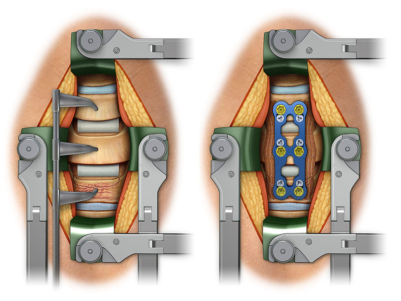 Cervical Fusion