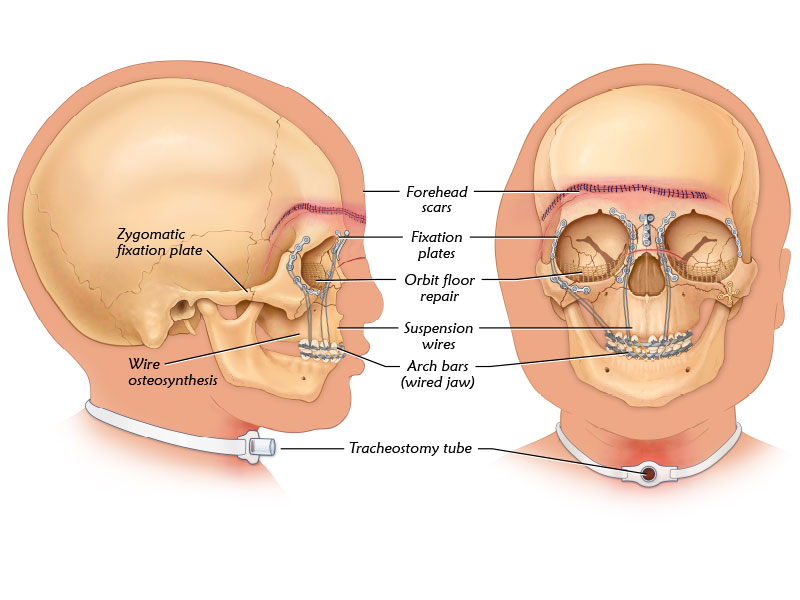 Pediatric Head Trauma