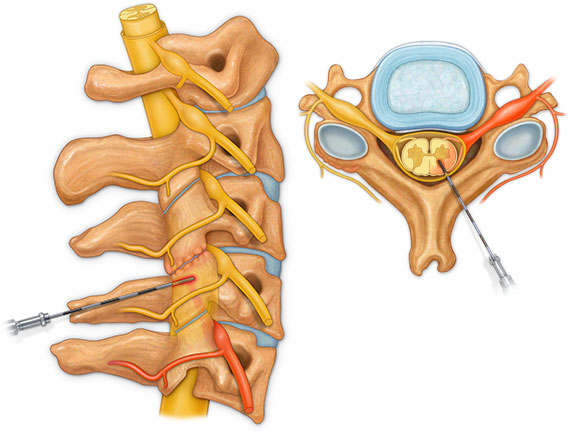 Spinal Injection